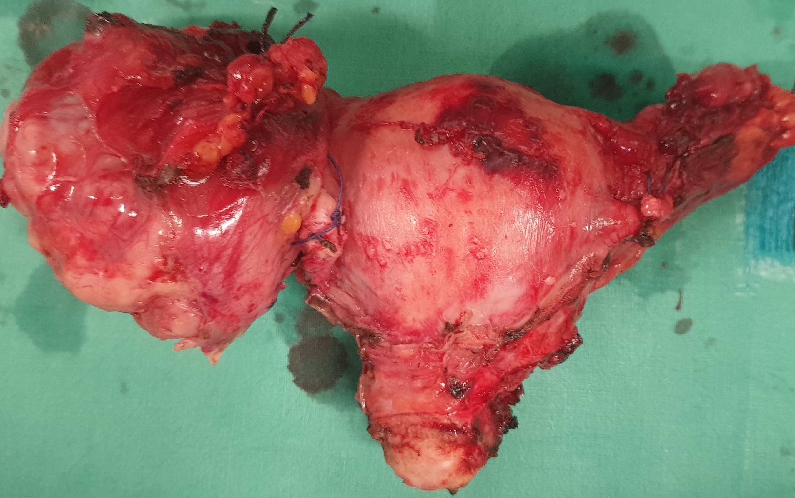 TOTAL HYSTERECTOMY
