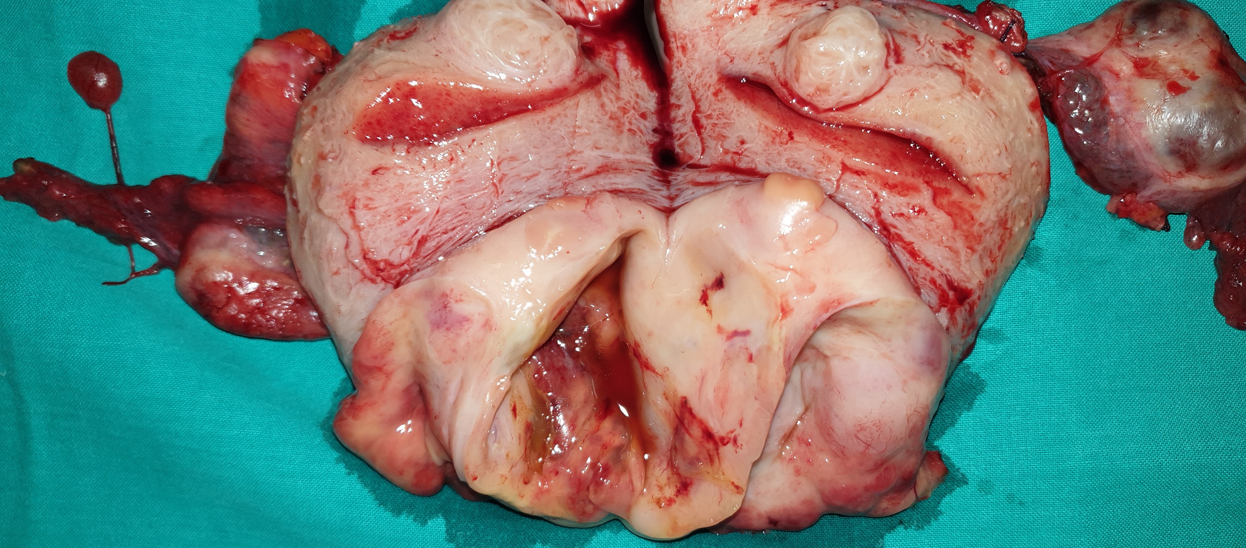 TOTAL HYSTERECTOMY