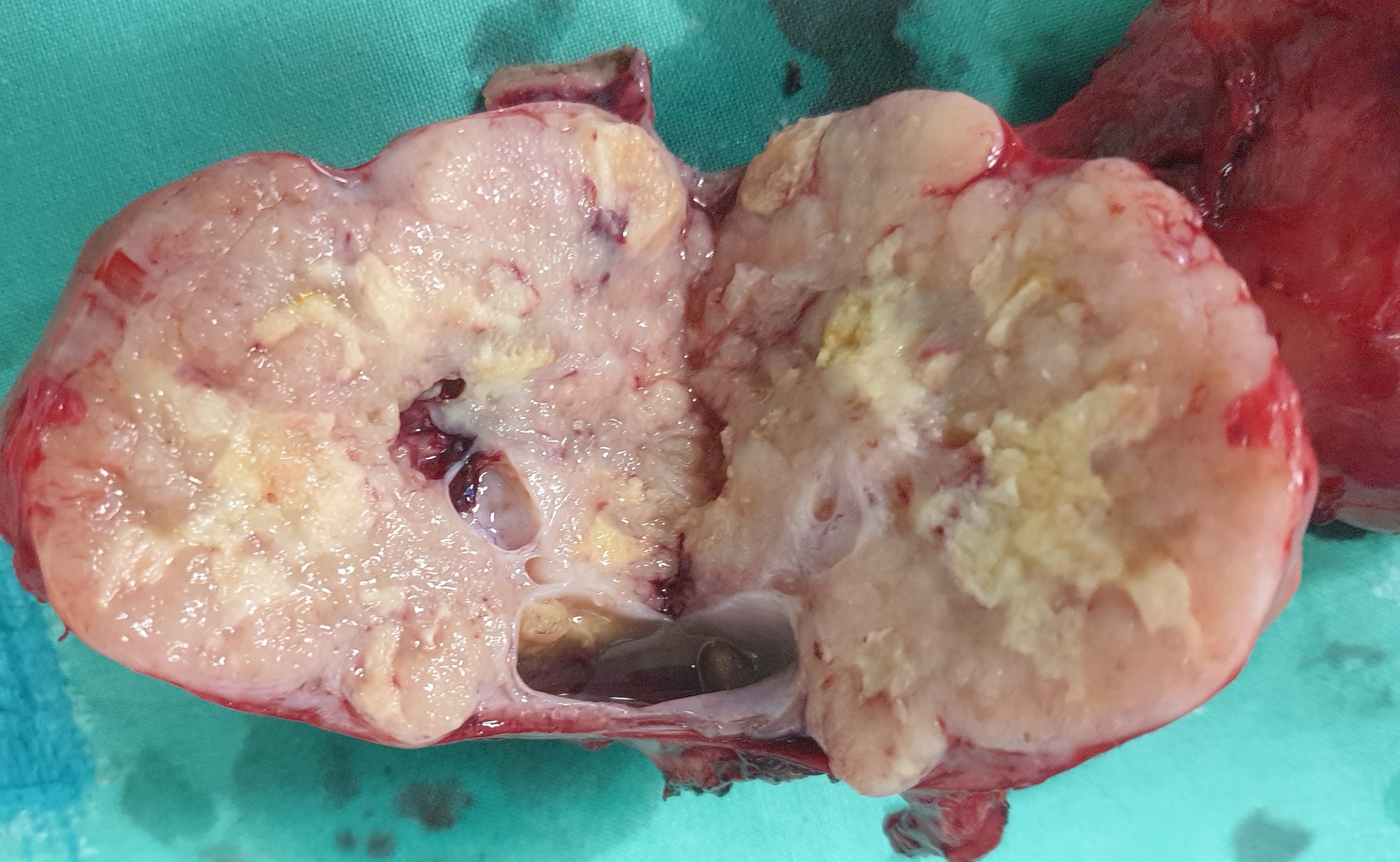 TOTAL HYSTERECTOMY