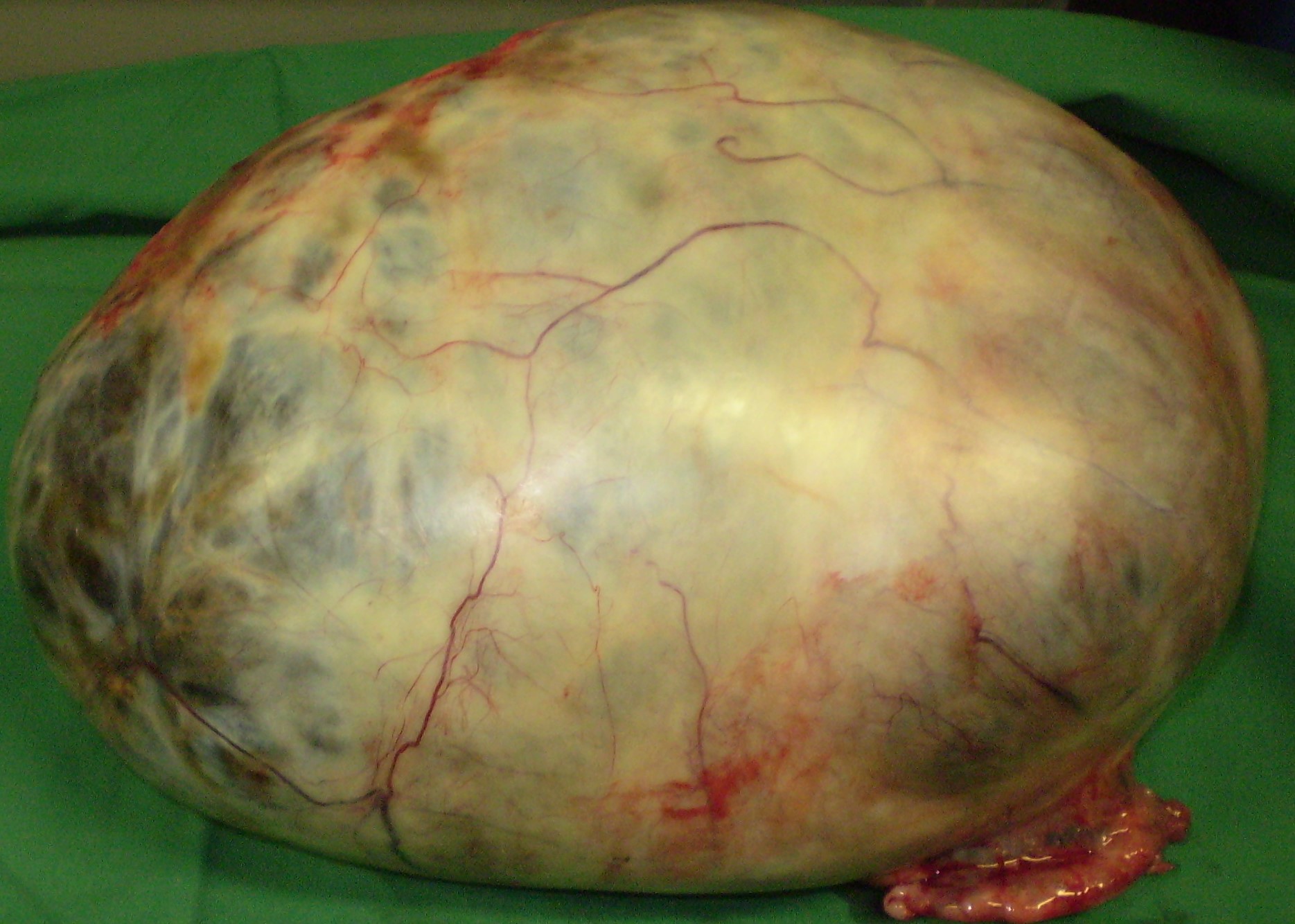 OVARIAN CYSTEDENOMA