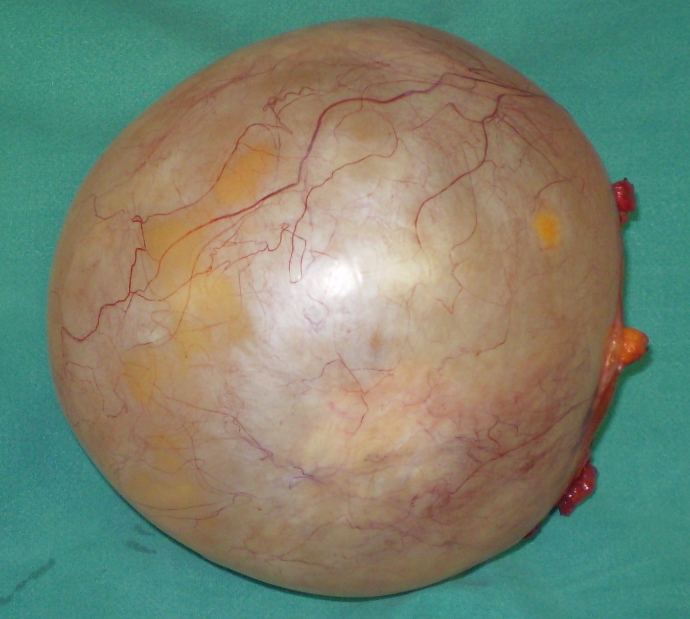 OVARIAN CYSTEDENOMA