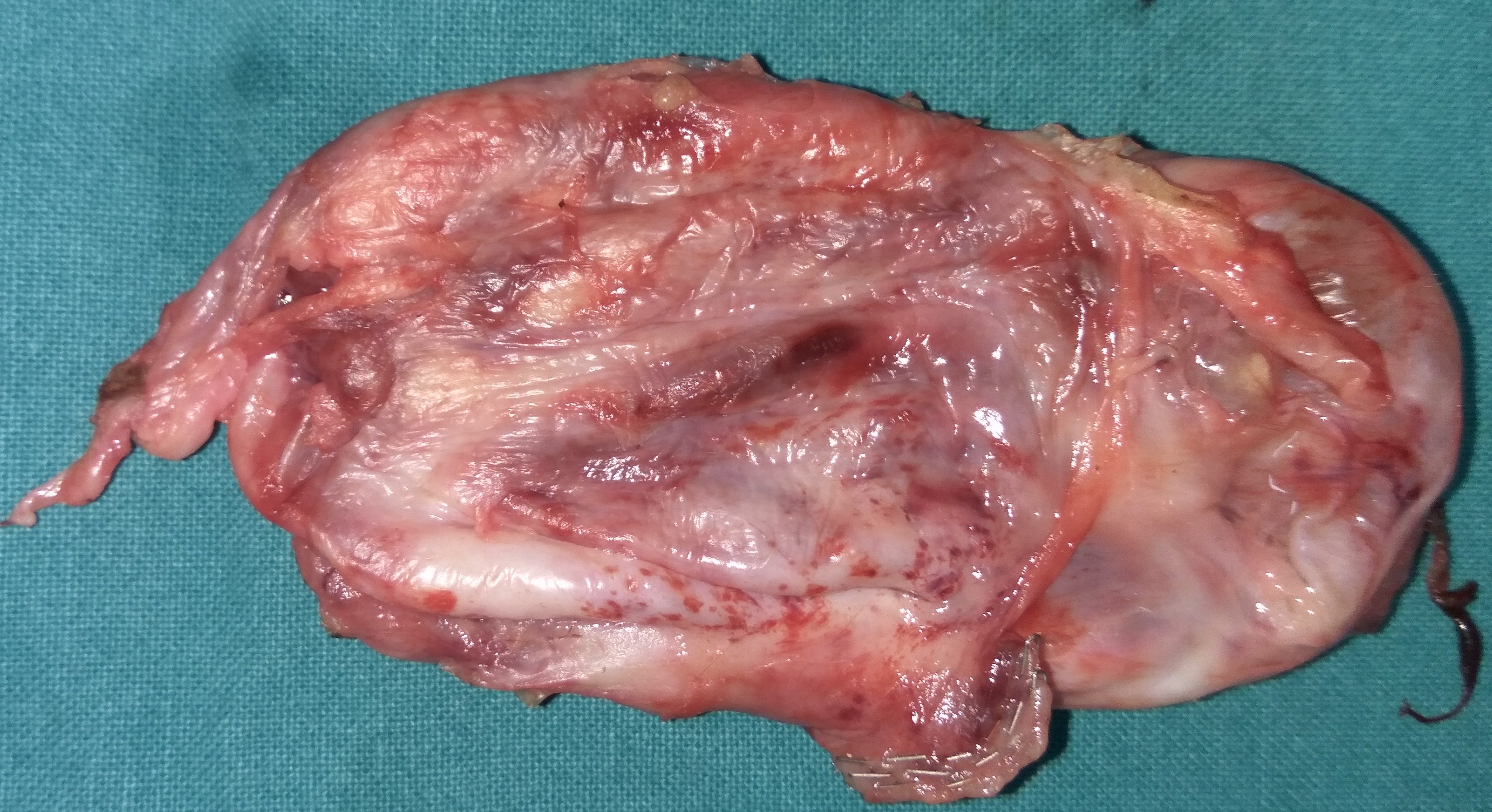 OVARIAN CYSTEDENOMA