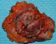 ENDOMETRIOMA