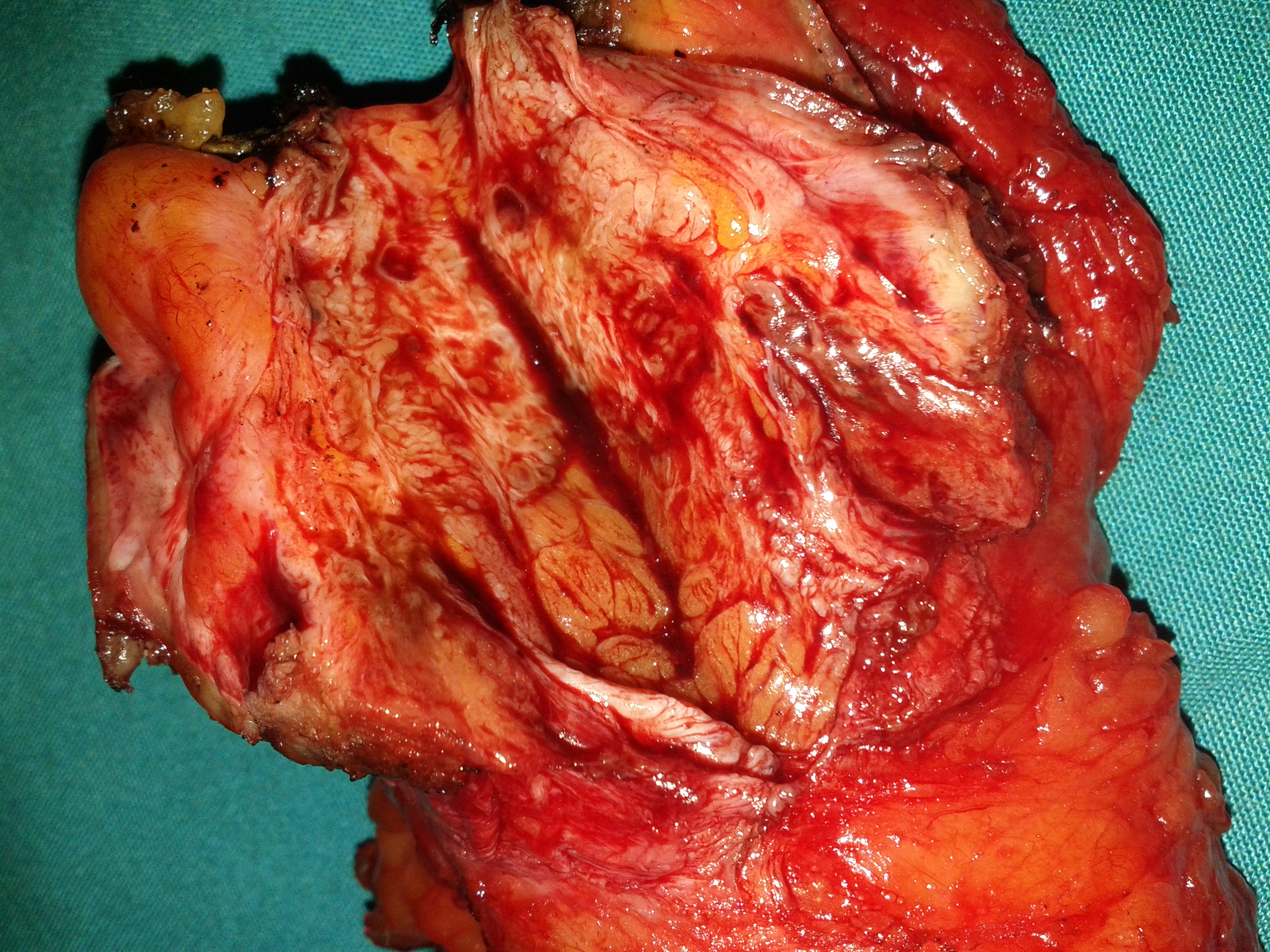 ABDOMINAL WALL ENDOMETRIOMA