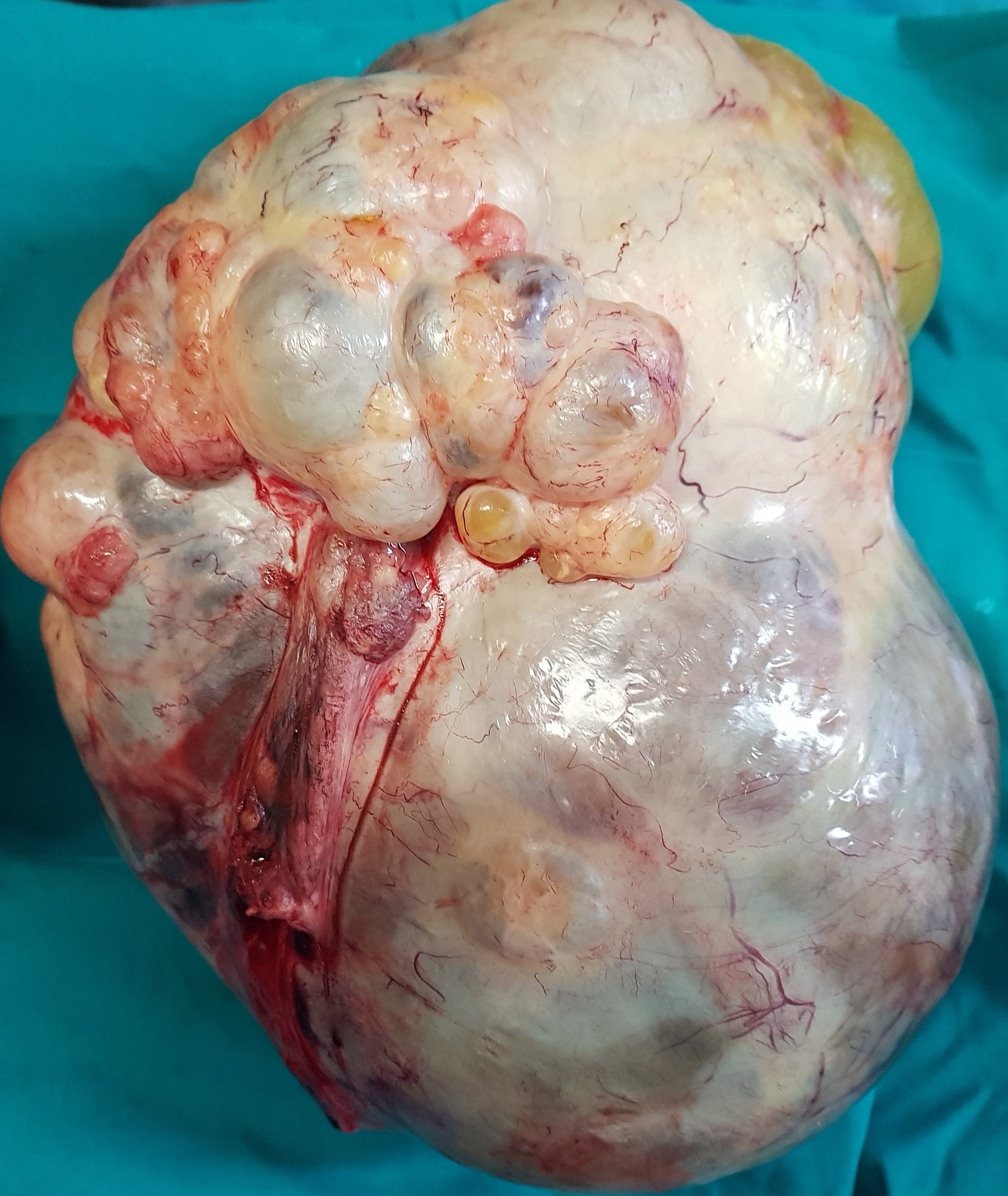 OVARIAN CARCINOMA
