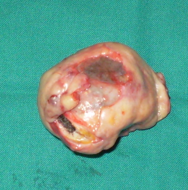 OVARIAN HAMARTOMA