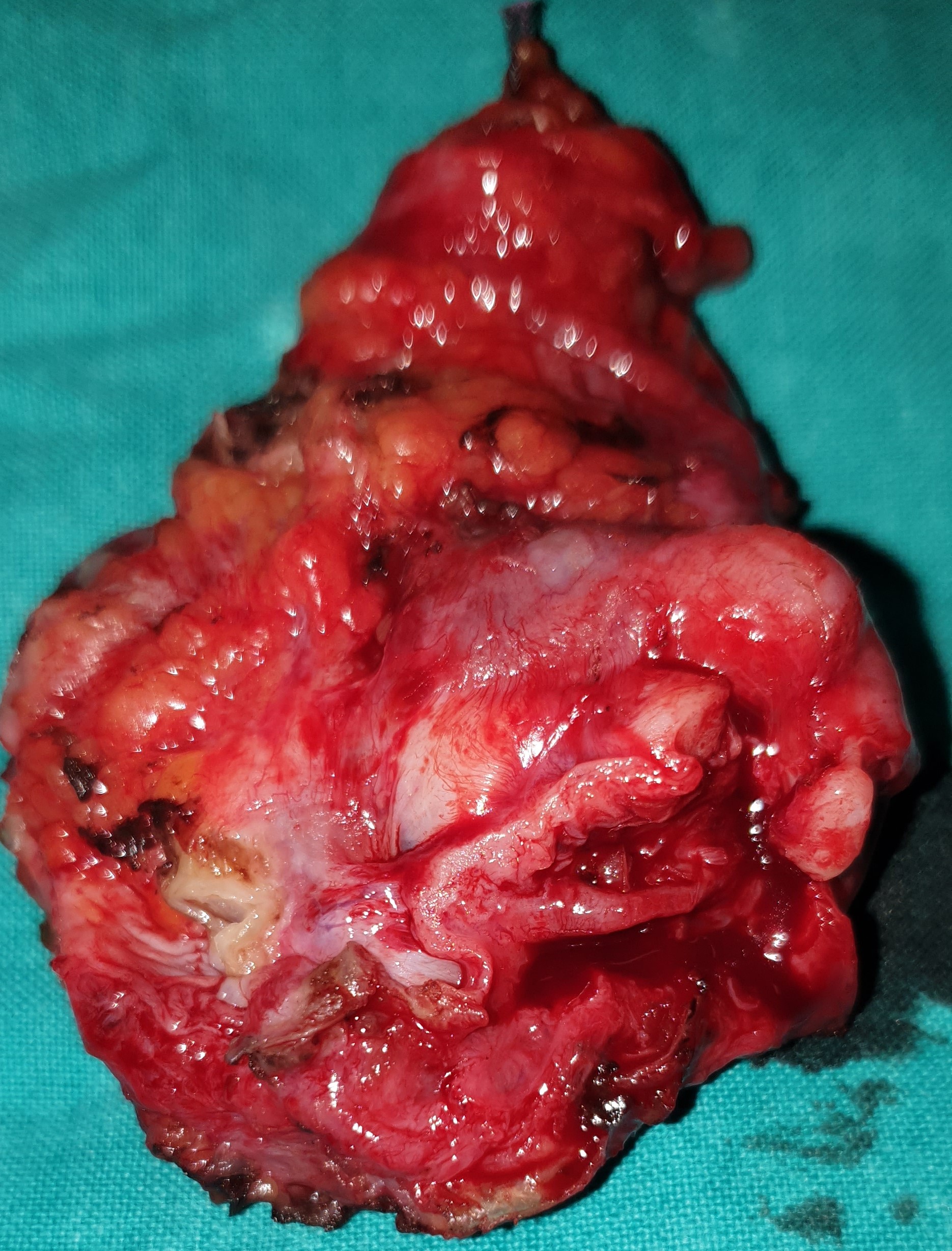 OVARIAN CYST