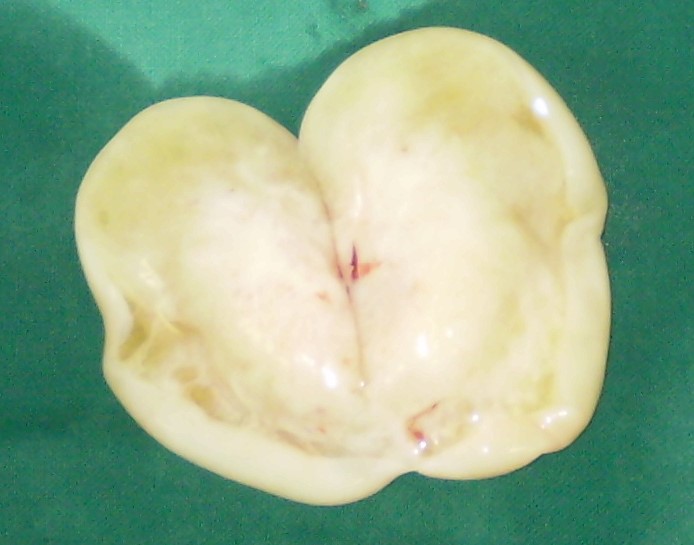 OVARIAN FIBROTHECOMA
