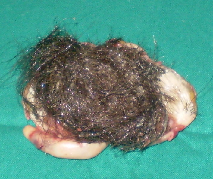 OVARIAN HAMARTOMA