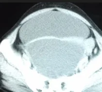 PARAOVARIAN CYST
