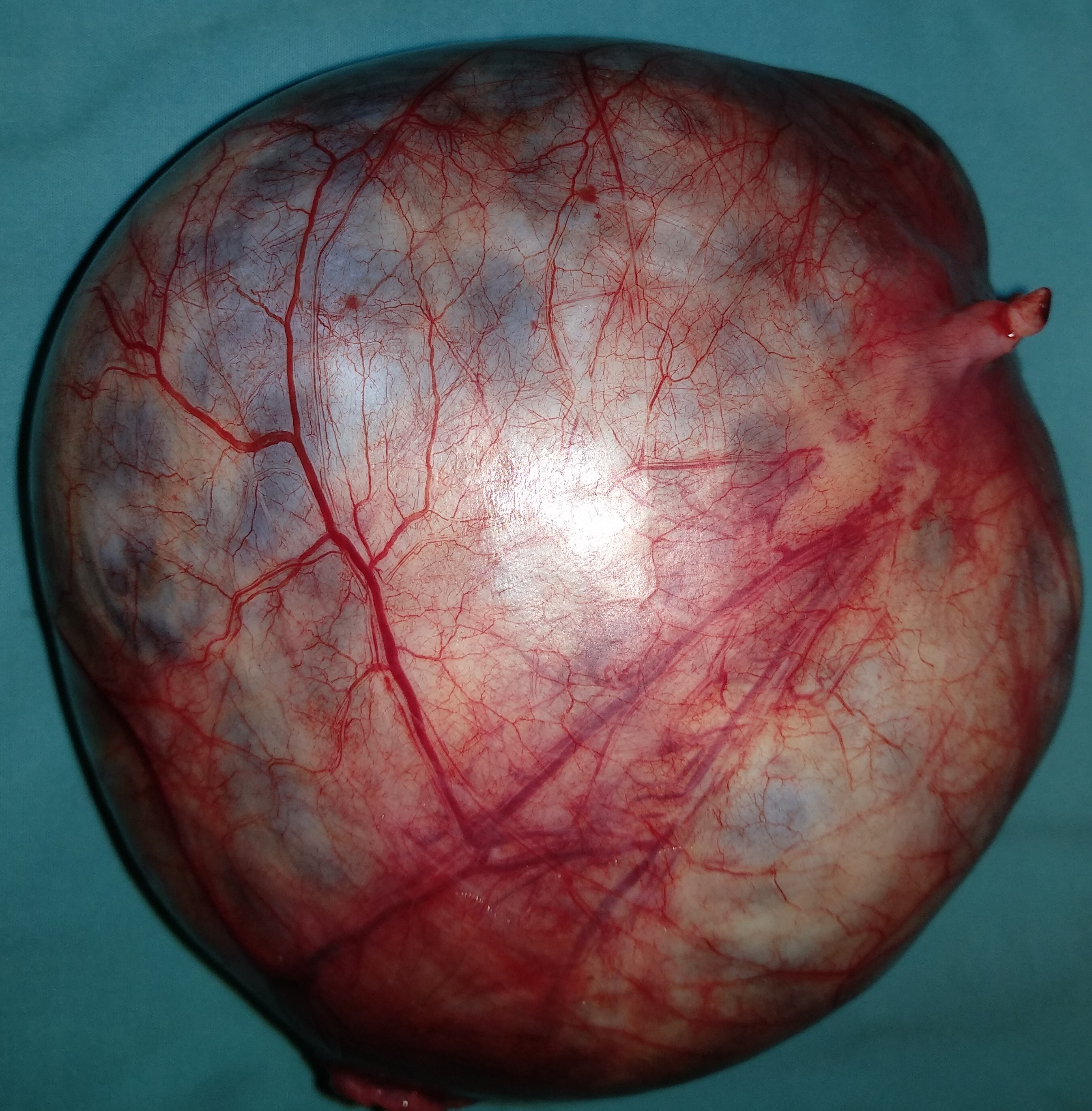 SEROUS CYSTADENOMA