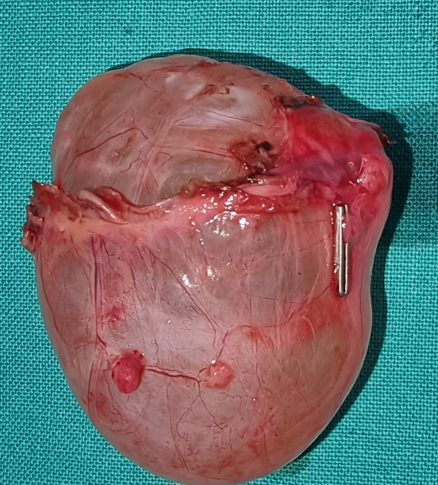 OVARIAN CYST