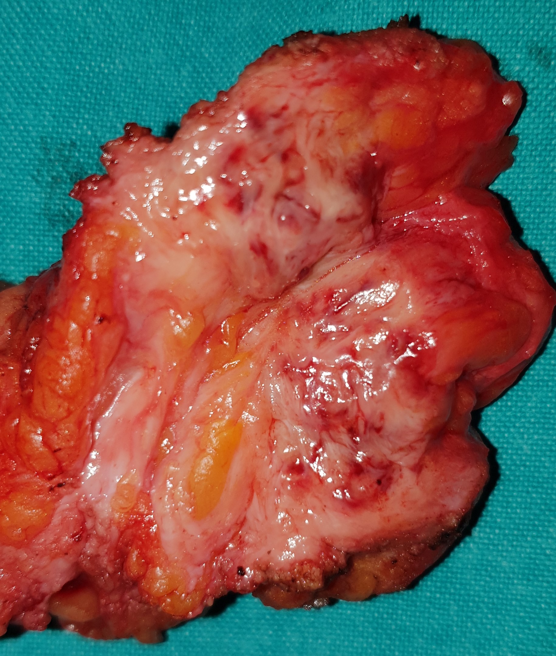 ABDOMINAL WALL ENDOMETRIOMA