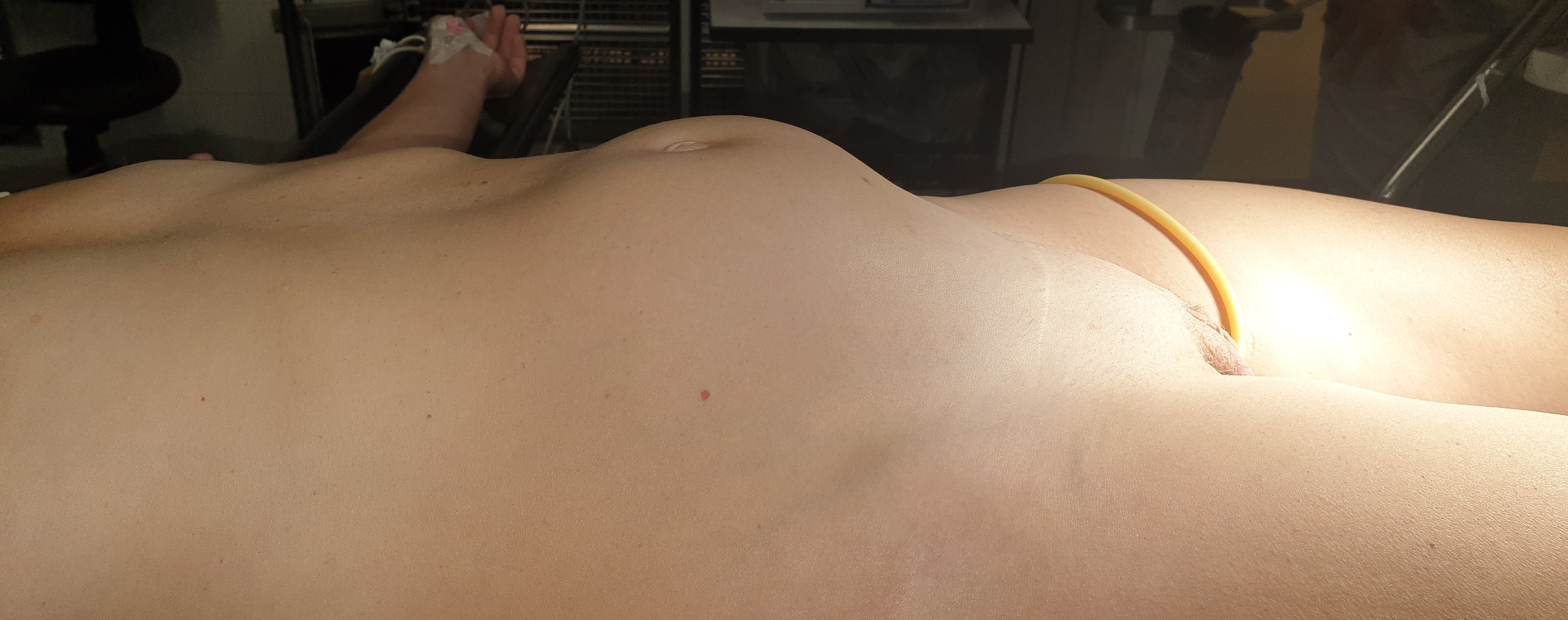 GIANT UTERINE LEIOMYOMA