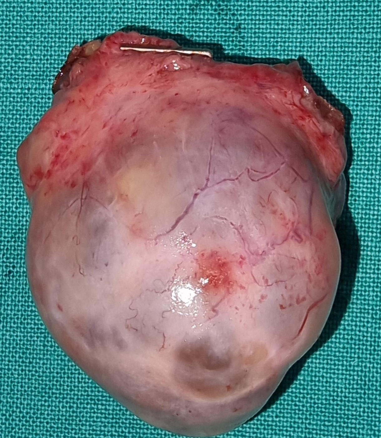 OOPHORECTOMY SPECIMEN