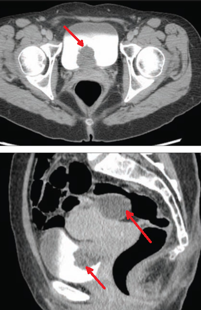 URINARY BLADDER ENDOMETRIOSIS