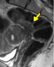 DEEP ENDOMETRIOSIS