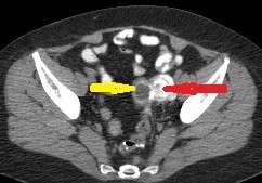 OVARIAN CARCINOMA RECURRENCE