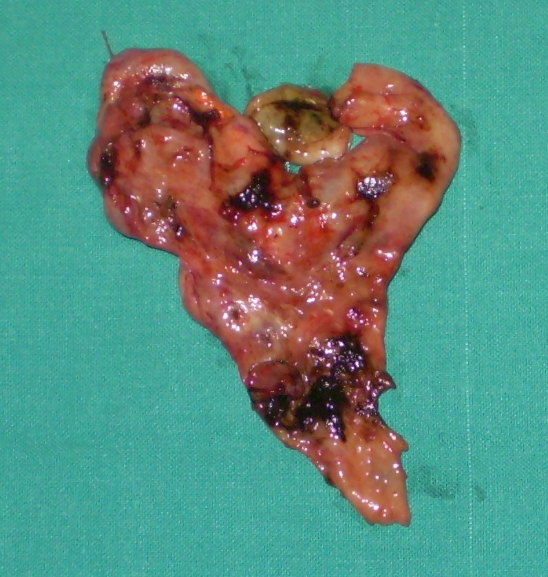 OVARIAN ENDOMETRIOMA