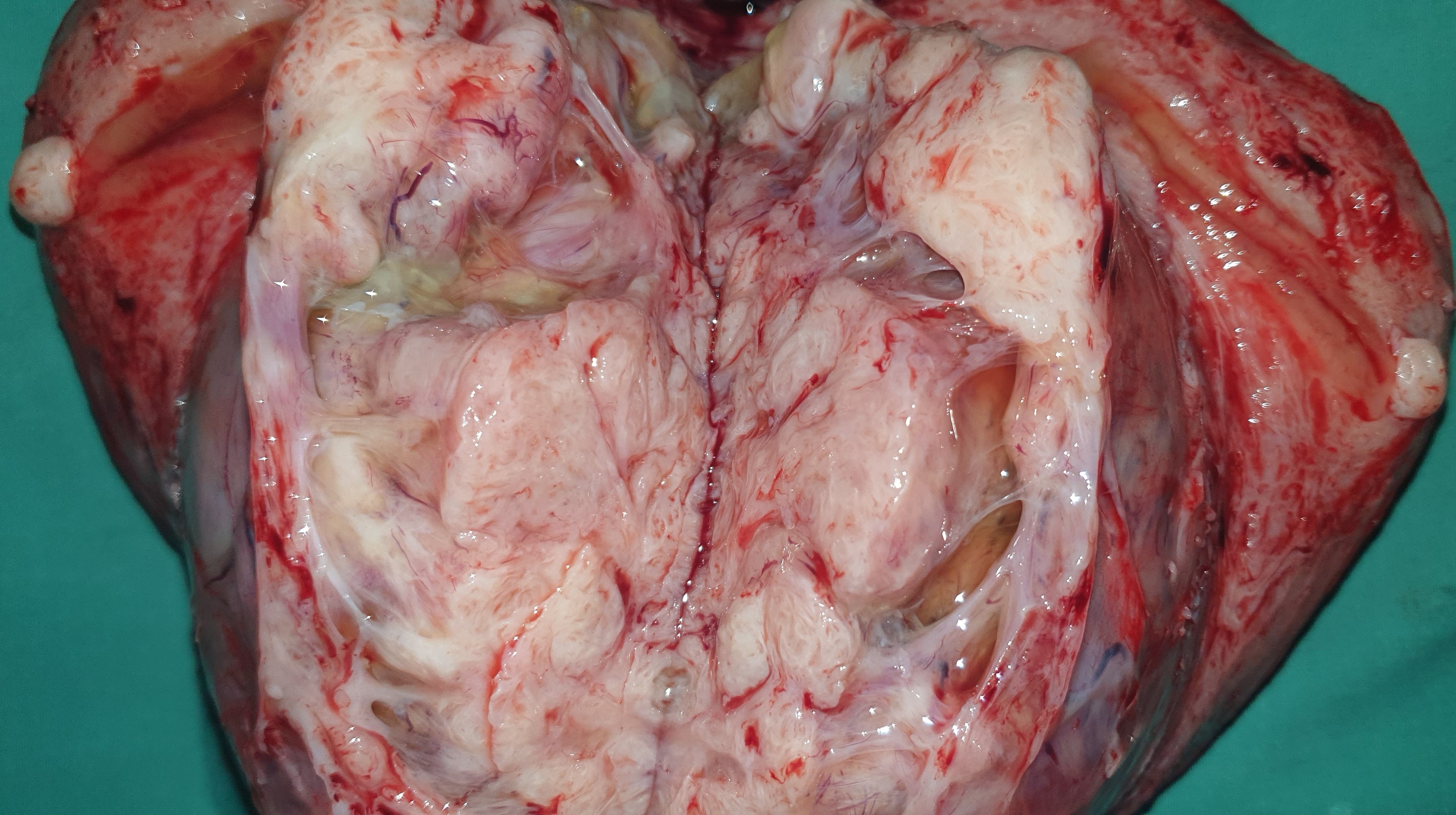 GIANT UTERINE LEIOMYOMA