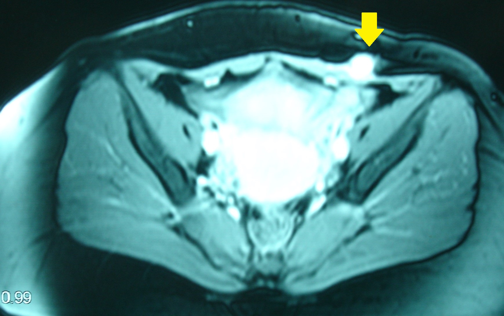 ABDOMINAL WALL ENDOMETRIOMA