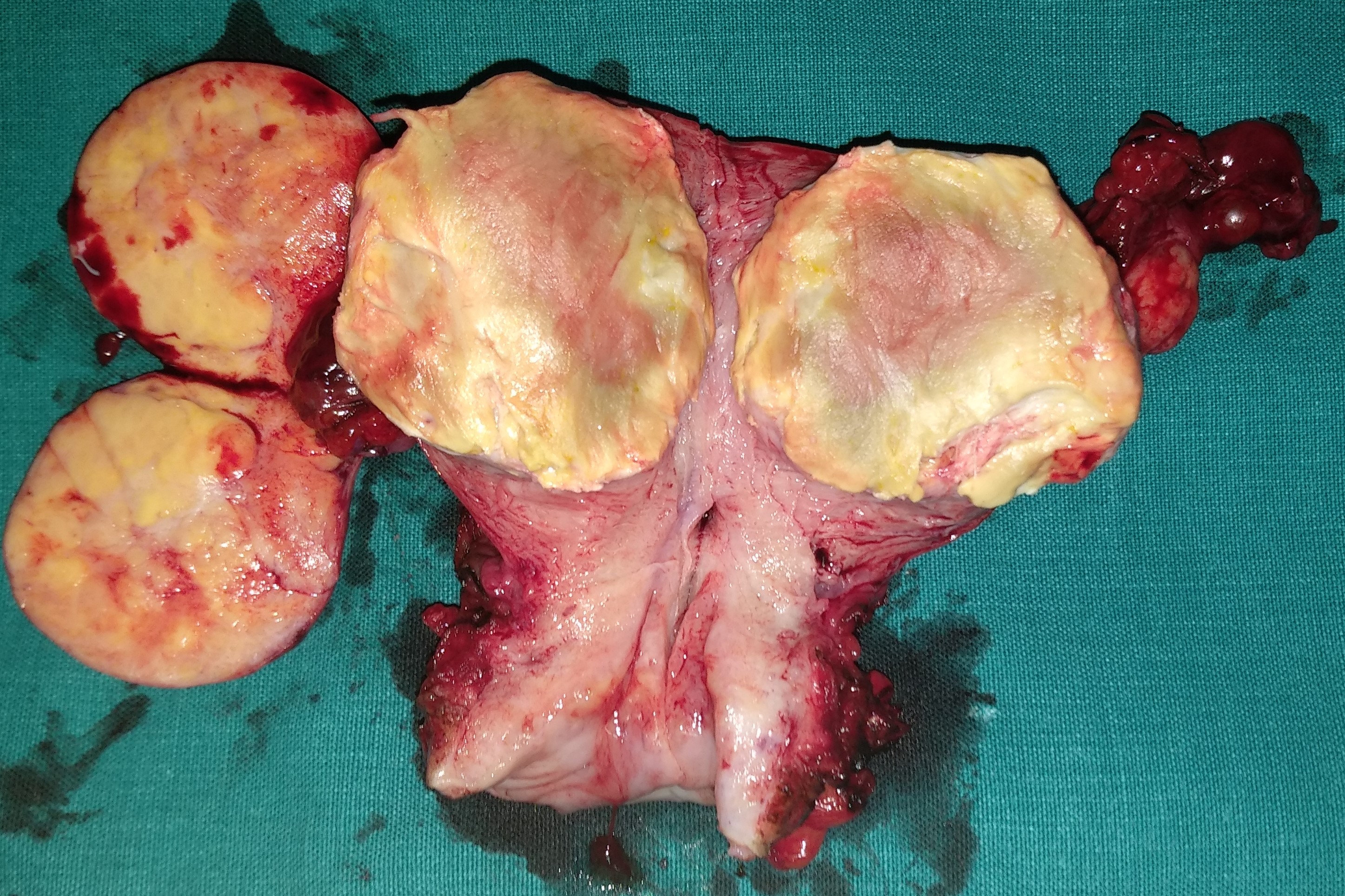 LEIOMYOMATOUS UTERUS + RIGHT OVARIAN THECOMA