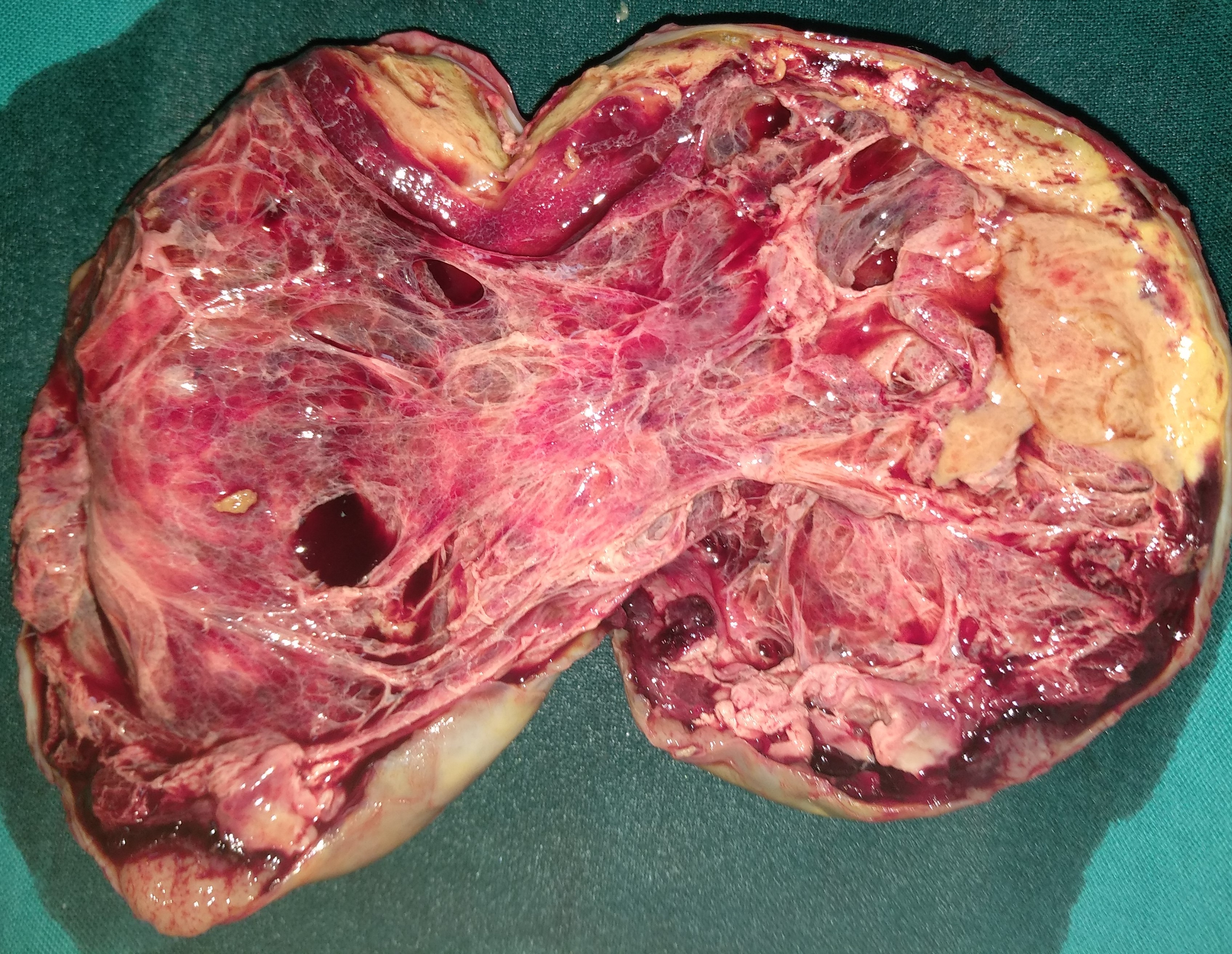 OVARIAN CARCINOMA RECURRENCE 