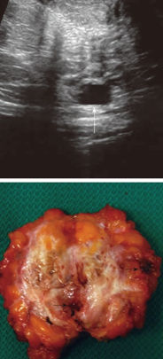 ABDOMINAL WALL ENDOMETRIOSIS