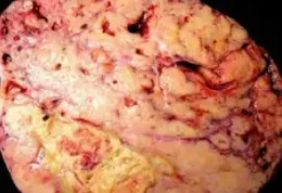 ADULT GRANULOSA CELL TUMOR