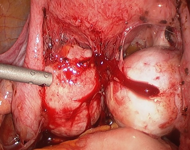 BILATERAL ENDOMETRIOMAS