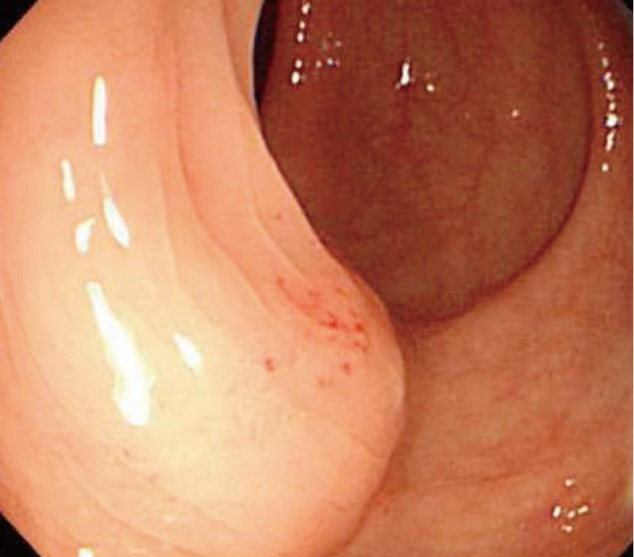 BOWEL ENDOMETRIOSIS
