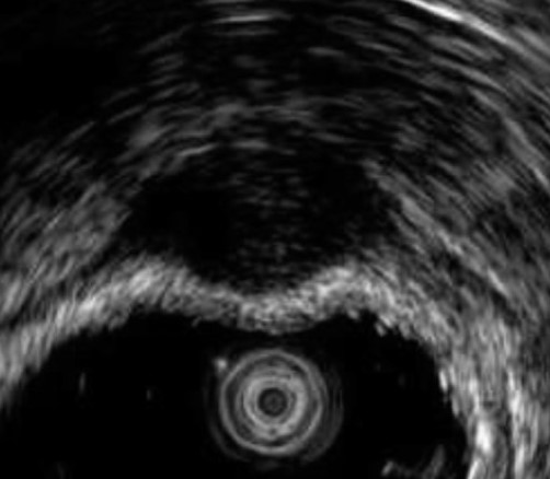 BOWEL ENDOMETRIOSIS
