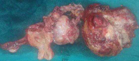 BRENNER'S TUMOR