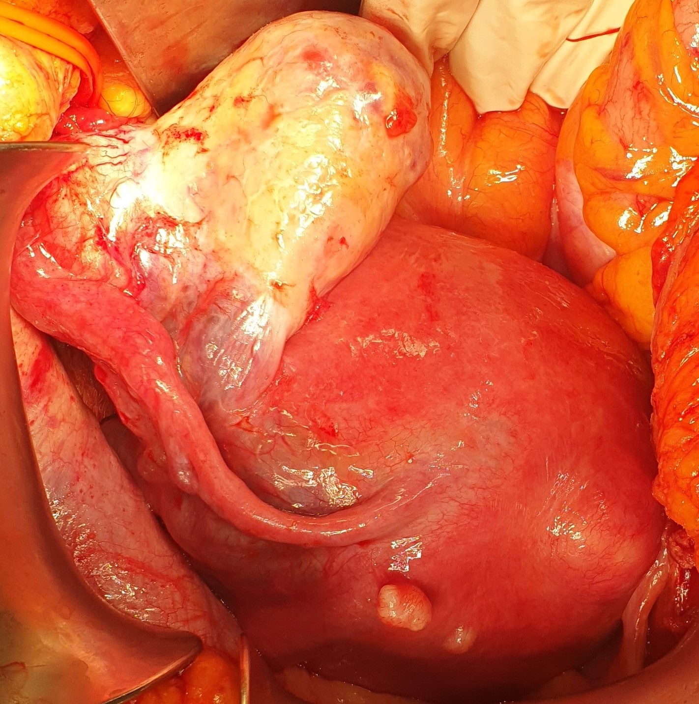 BRENNER'S TUMOR