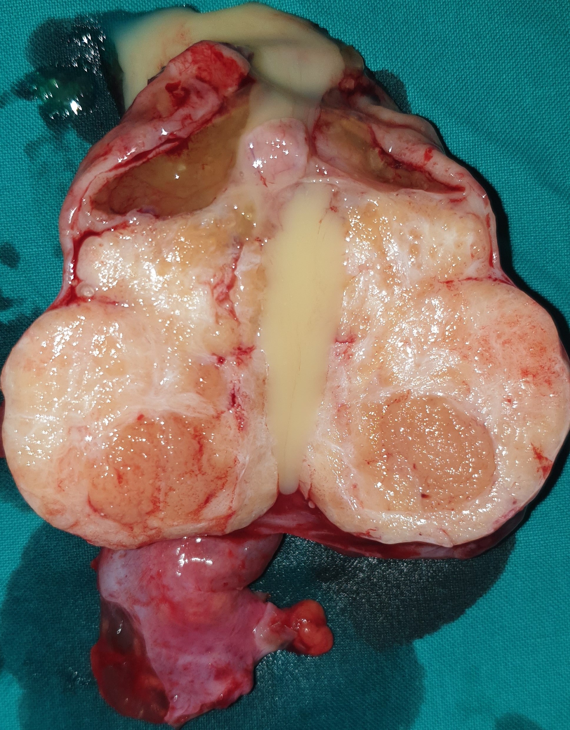 BRENNER'S TUMOR