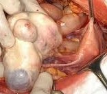 BRENNER'S TUMOR