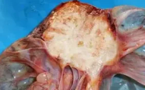 BRENNER TUMOR WITH MUCINOUS CYSTADENOMA