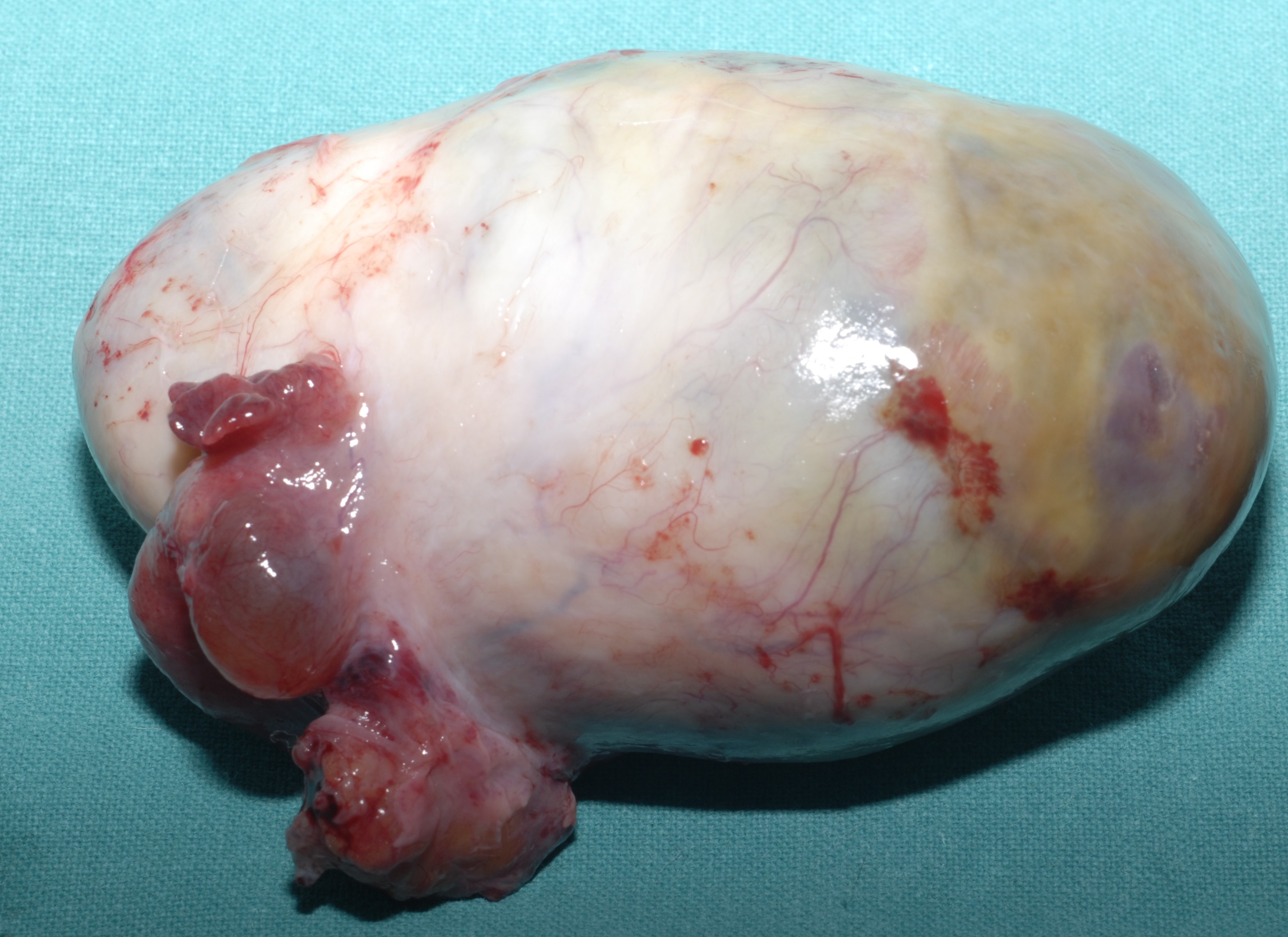 OVARIAN CARCINOMA