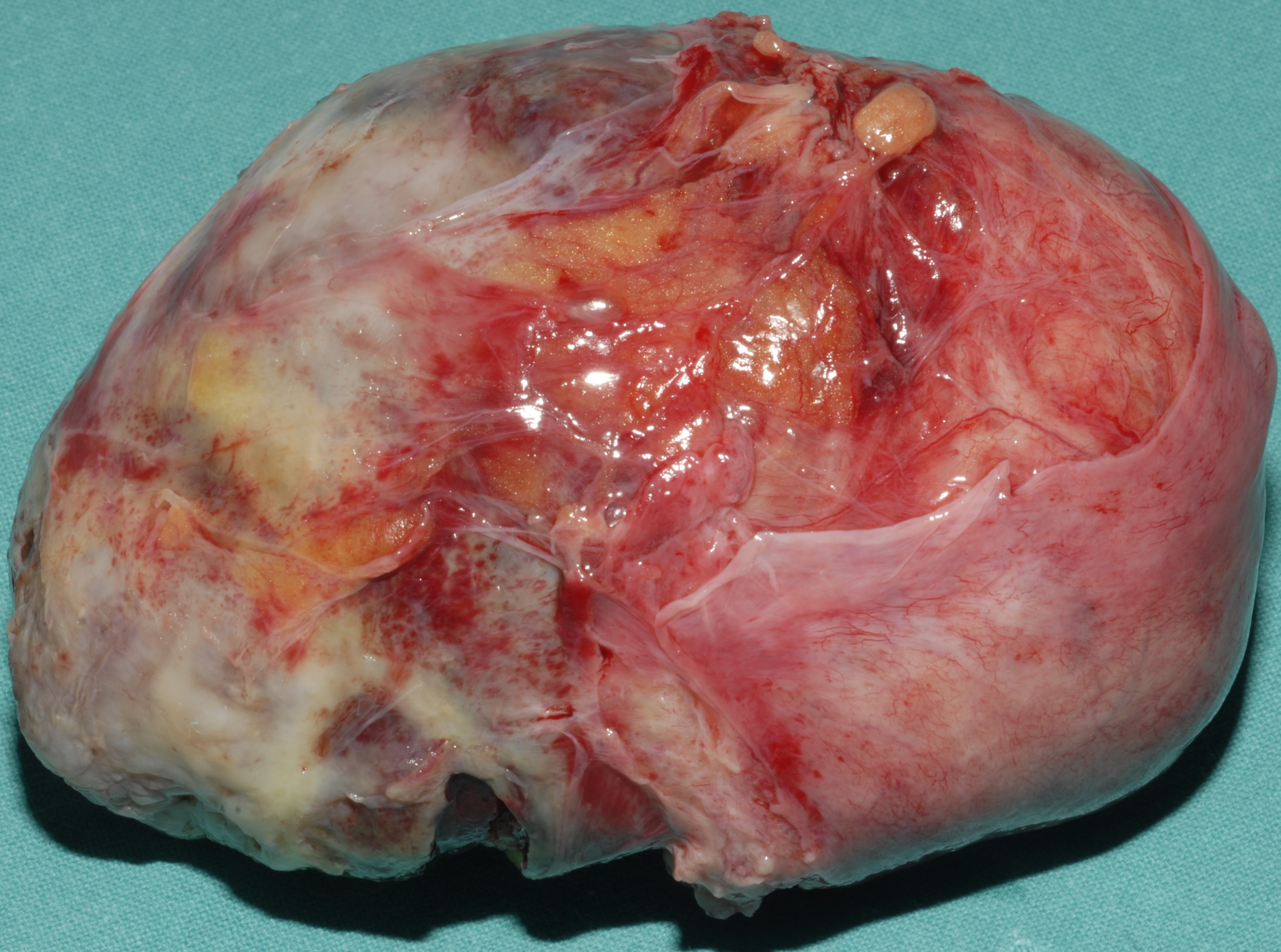 OVARIAN CARCINOMA