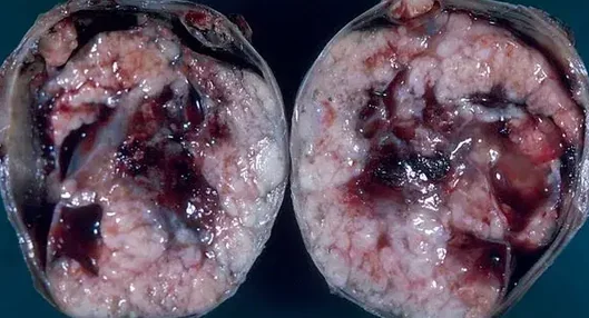 CLEAR CELL OVARIAN TUMOR