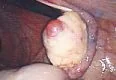 CORPUS LUTEAL CYST