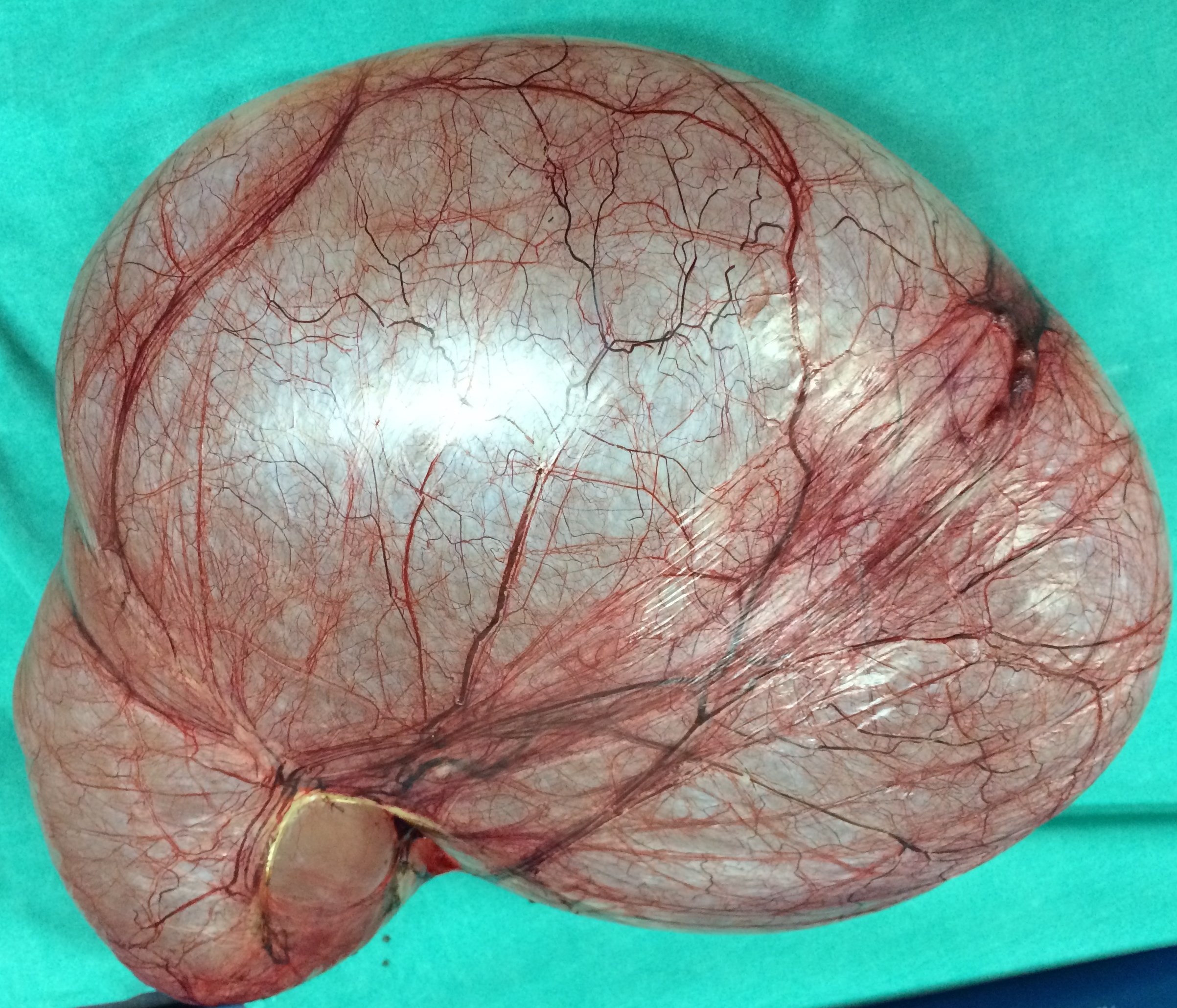 OVARIAN CYSTADENOMA