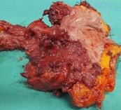 CYSTIC OVARIAN ADENOCARCINOMA