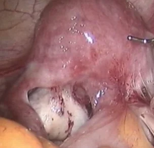 DEEP INFILTRATING ENDOMETRIOSIS