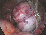 DERMOID CYST