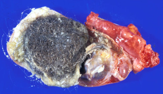 OVARIAN DERMOID CYST