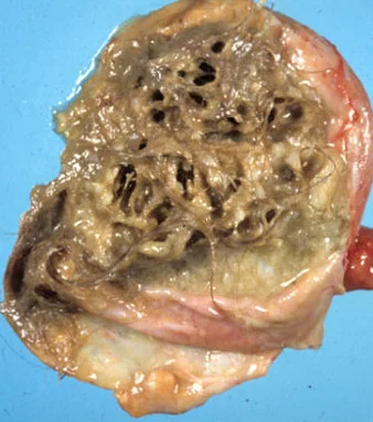 DERMOID CYST