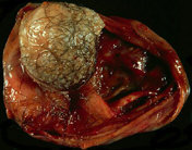 DERMOID CYST