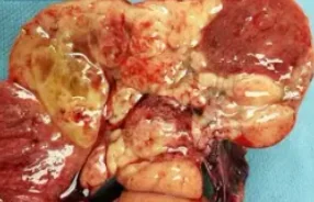 DYSGERMINOMA