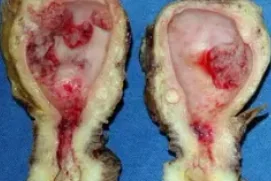 ENDOMETRIAL CARCINOMA